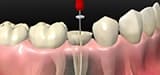 歯根管治療