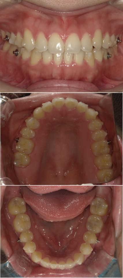 インビザライン（全顎マウスピース矯正）後
