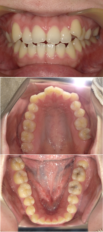 インビザライン（全顎マウスピース矯正）前